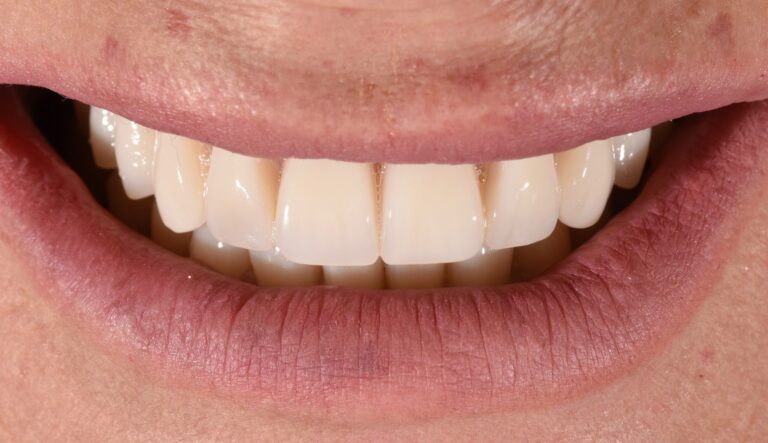 Denti fissi in poche ore: il caso di implantologia a carico immediato a Lanciano e Guardiagrele