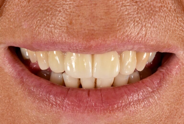 Hai una vecchia protesi sui denti davanti che non ti soddisfa più? Il caso di un sorriso rinato