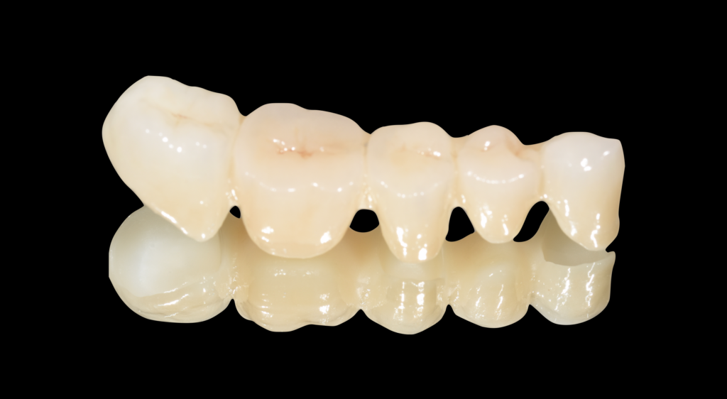 Corone in zirconio ceramica a Lanciano e Guardiagrele